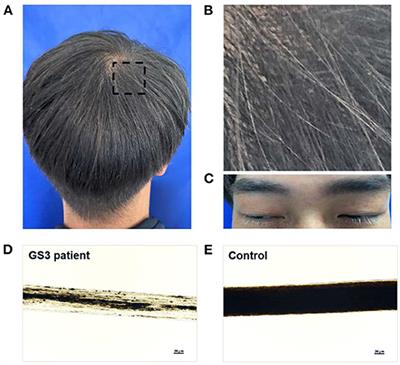 Identification of a Novel MLPH Missense Mutation in a Chinese Griscelli Syndrome 3 Patient